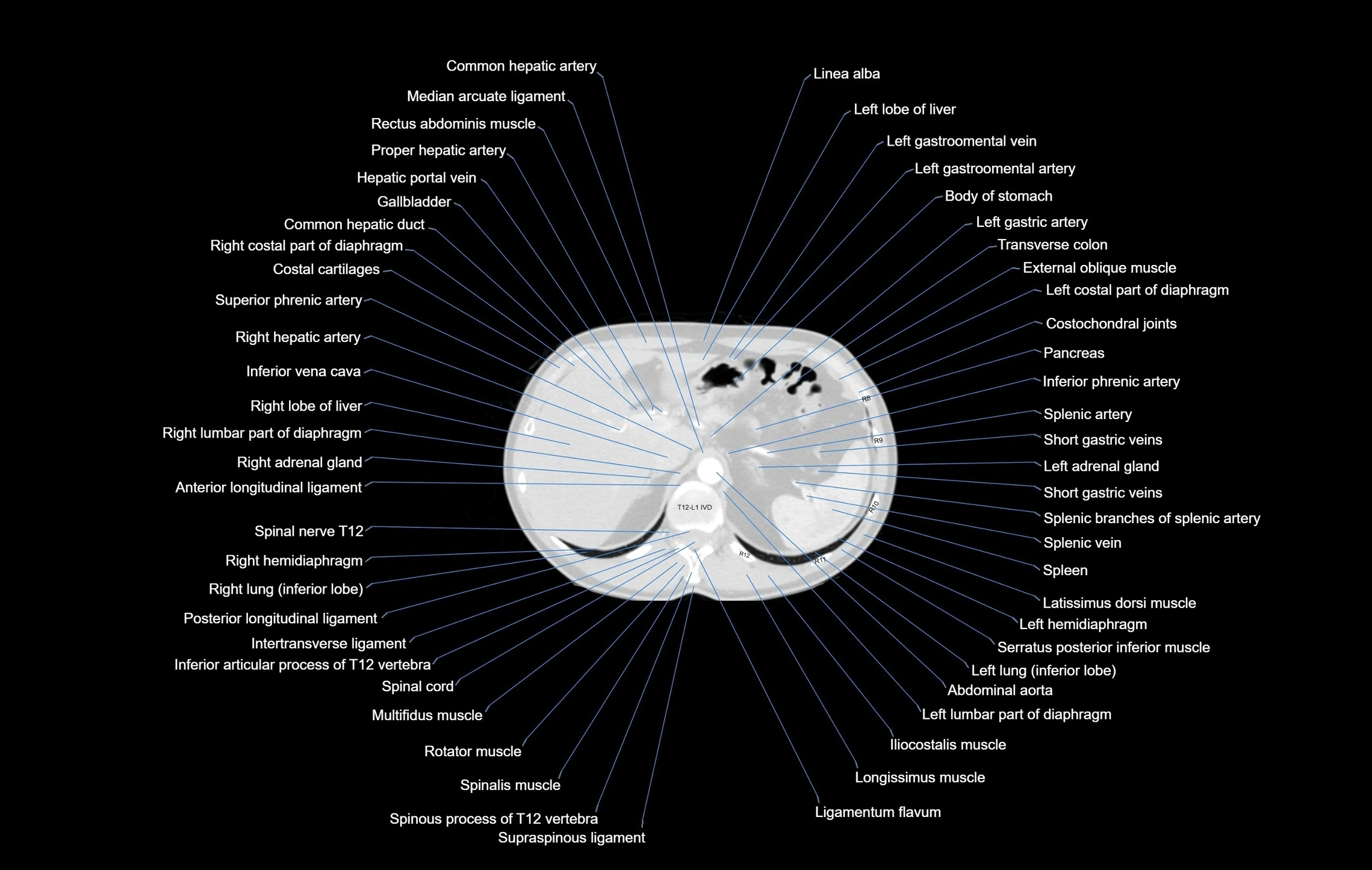CT chest (thorax) lung window window labelled axial cross sectional anatomy radiology image-00117.webp